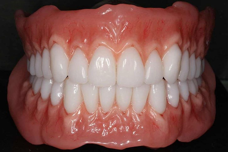 Jaw Registration For Partial Dentures Albion RI 2802